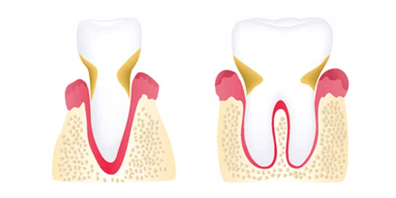Moderate periodontitis illustration